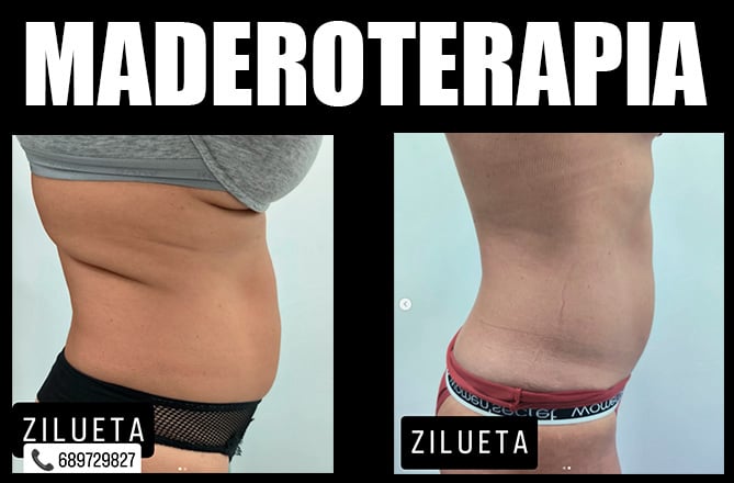 Maderoterapia para el abdomen